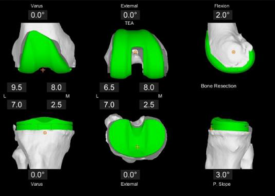 3D knee image