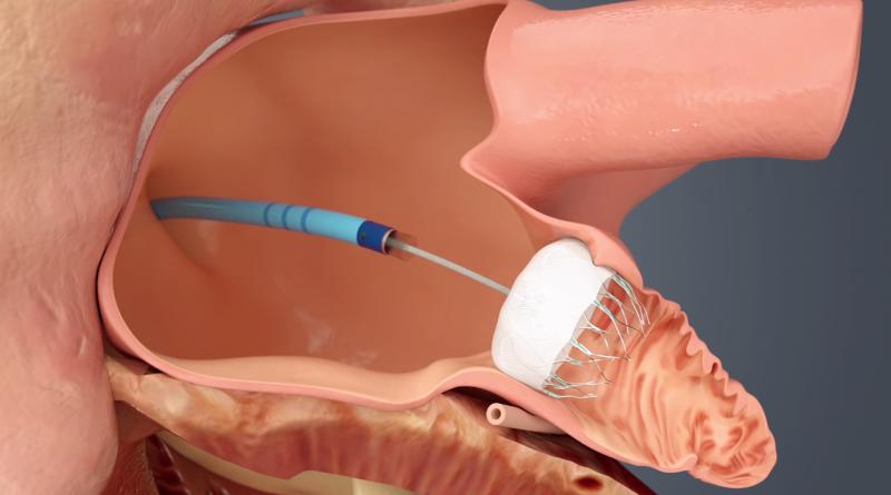 Left Atrial Appendage Closure Device